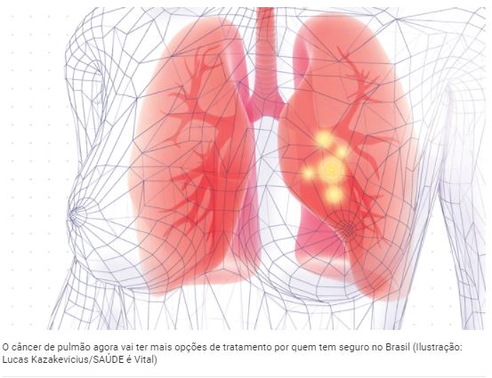 Cancer Pulmao